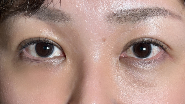 Postoperative Condition Part 1