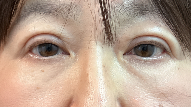 手术前的状态 其一