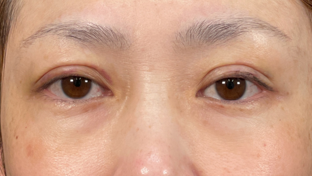 手術前の状態 その1