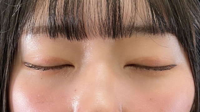 手術前の状態 その1