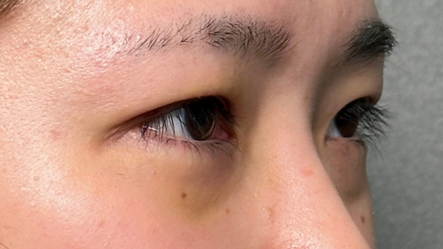 手术前的状态 其一