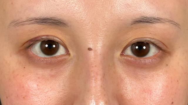 手术前的状态 其一