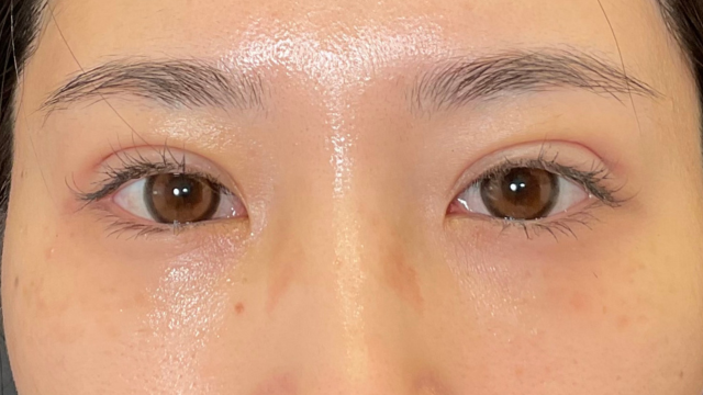 手术前的状态 其一