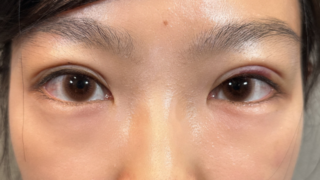 手术前的状态 其一