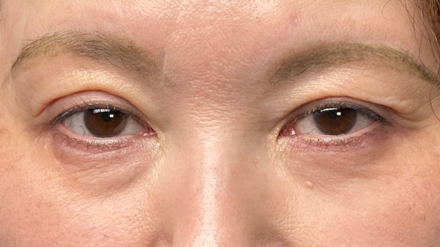 手术前的状态 其一