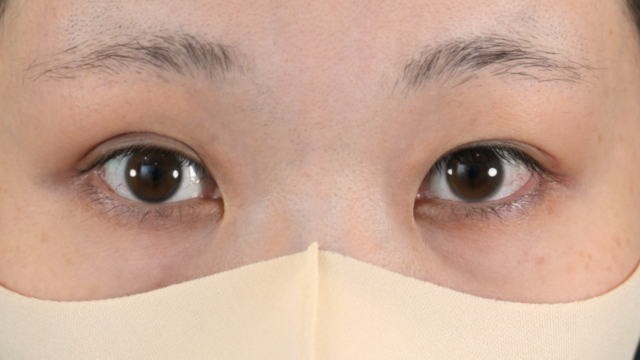 手术前的状态 其一