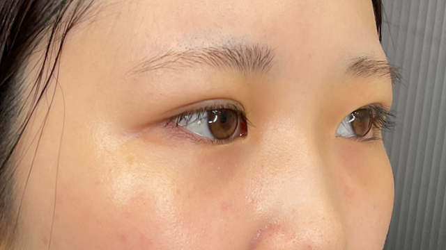 手术前的状态 其一