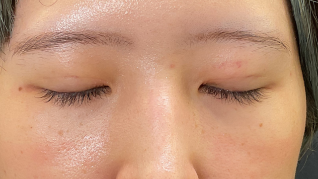 手術前の状態 その1