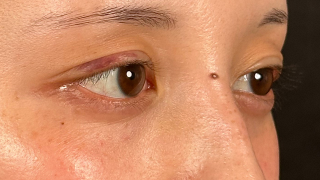 手术前的状态 其一