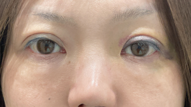 手術前の状態 その1