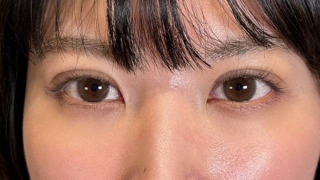 手術前の状態 その1