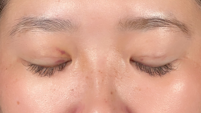 手术前的状态 其一