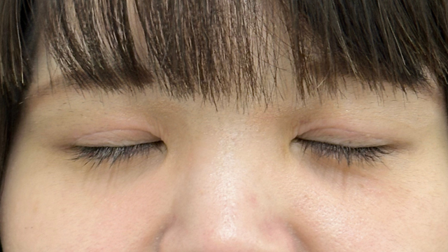 手術前の状態 その1