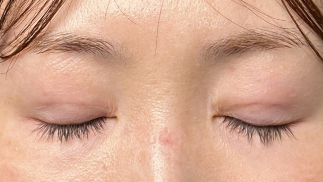 手術前の状態 その1