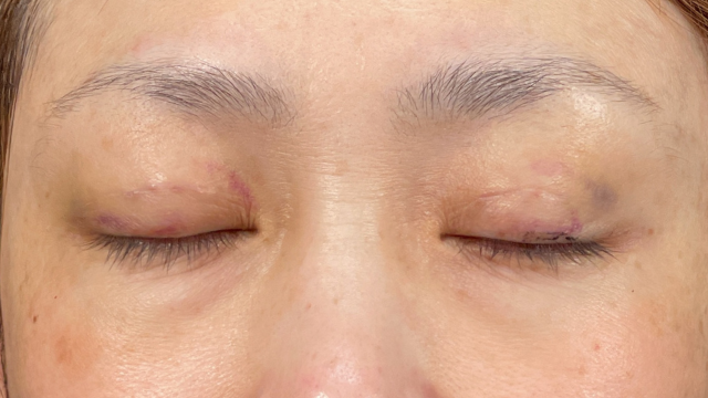 手術前の状態 その1