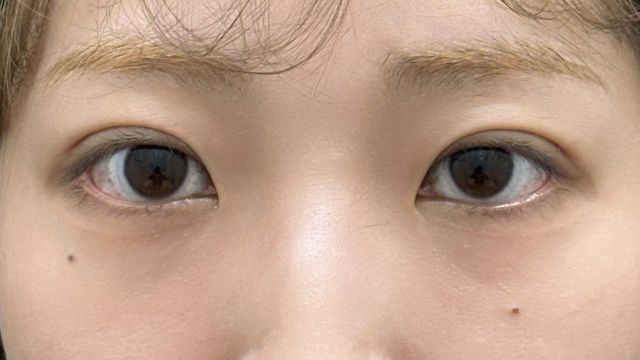 手术前的状态 其一