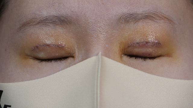 手術前の状態 その1