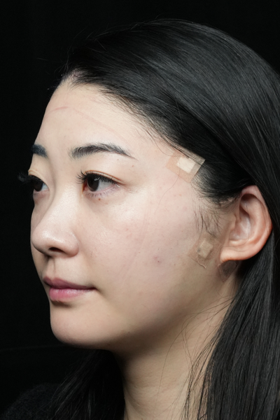 手术前的状态 其一