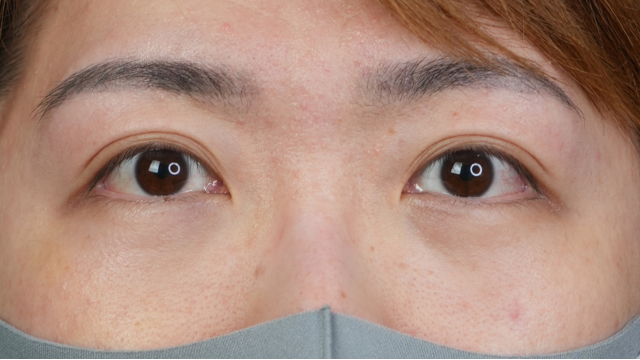 手术前的状态 其一