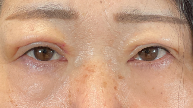 手术前的状态 其一