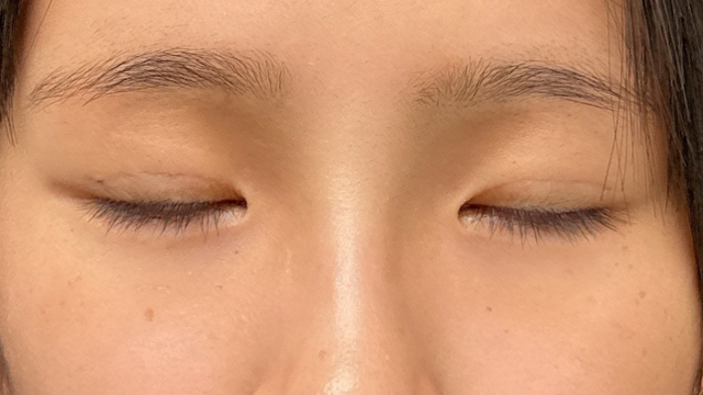 手术前的状态 其一