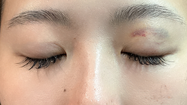 手術前の状態 その1