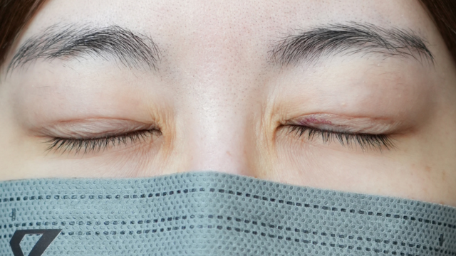 手术前的状态 其一