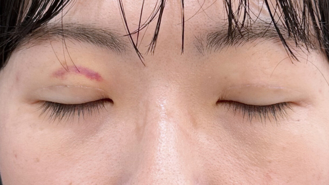 手術前の状態 その1