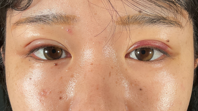 手术前的状态 其一