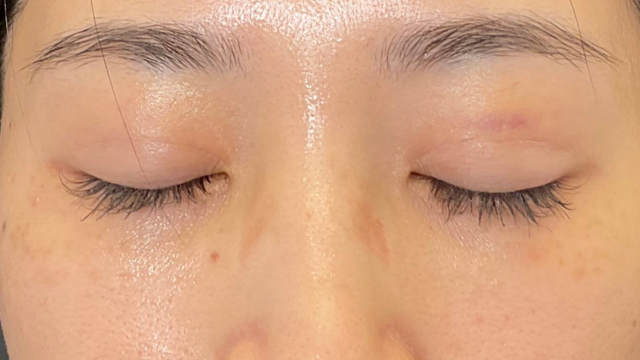 手术前的状态 其一