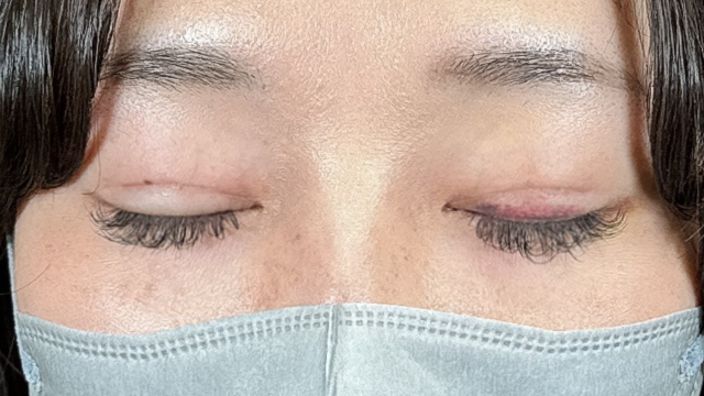 手术前的状态 其一