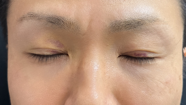 手术前的状态 其一