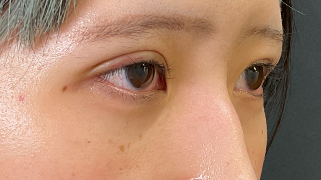 手術前の状態 その1