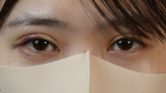 手术前的状态 其一