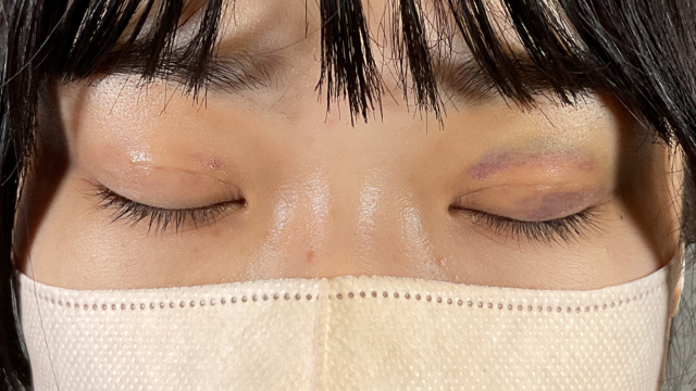 手术前的状态 其一