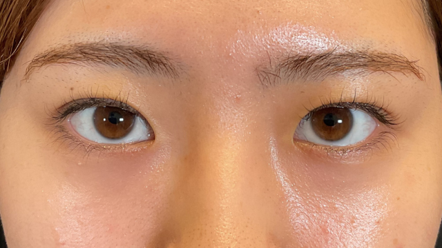 手術前の状態 その1