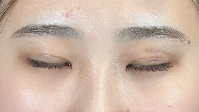 手术前的状态 其一