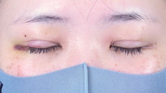 Postoperative Condition Part 1