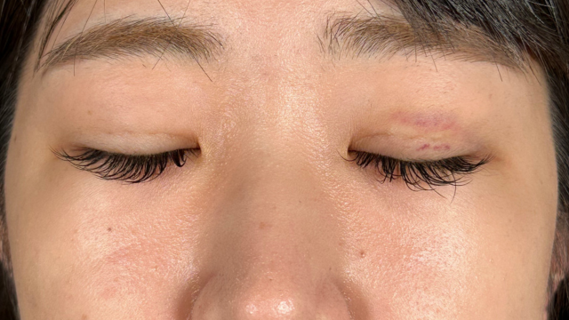 手术前的状态 其一