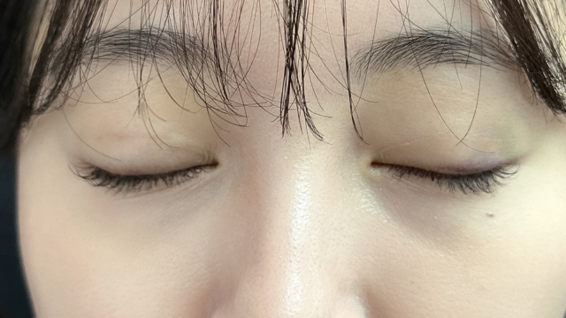 手术前的状态 其一