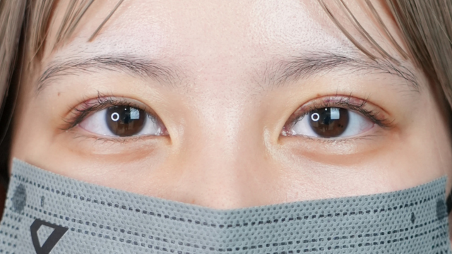 手術前の状態 その1