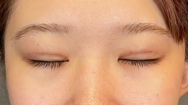 手術前の状態 その1