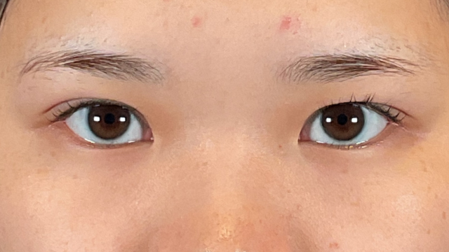 手術前の状態 その1