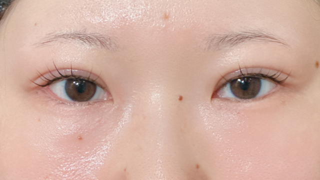 手术前的状态 其一