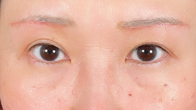 手术前的状态 其一