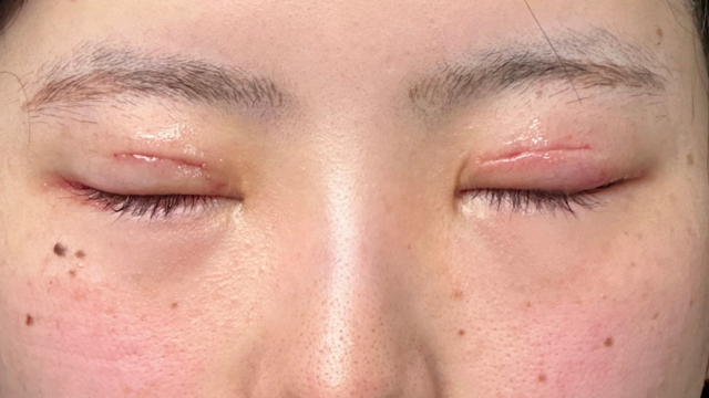 手術前の状態 その1