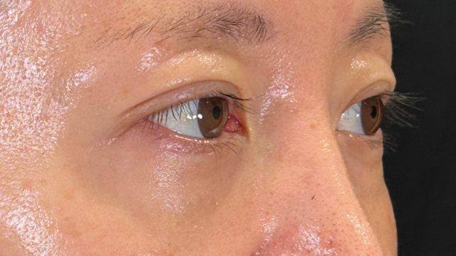 手術前の状態 その1