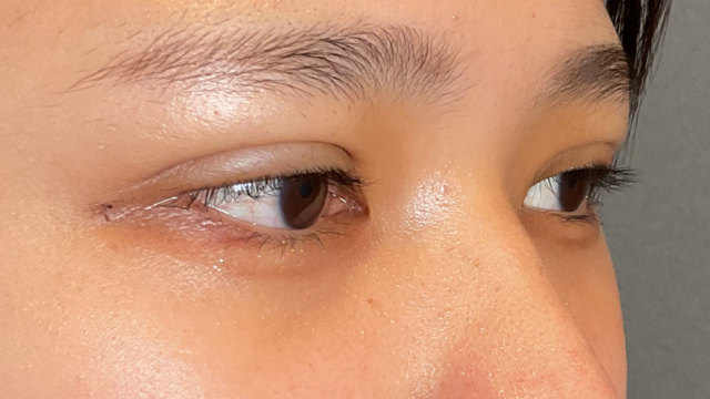 手術前の状態 その1