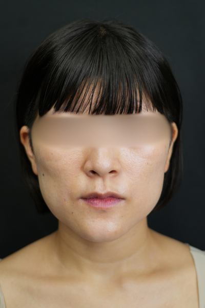 手术前的状态 其一