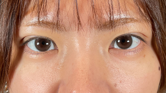 手术前的状态 其一